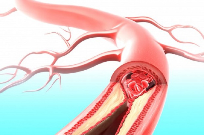 Aterosklerose: symptomer, diagnose, behandling og forebyggelse